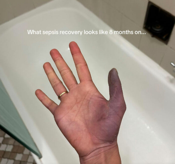 Hand showing severe discoloration and damage eight months after sepsis, warning young women about nail salon risks.