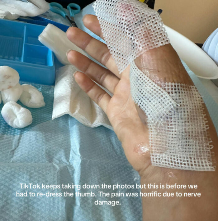 Close-up of a young woman’s injured hand with medical dressings warning about risks of going to nail salons after hospitalization.