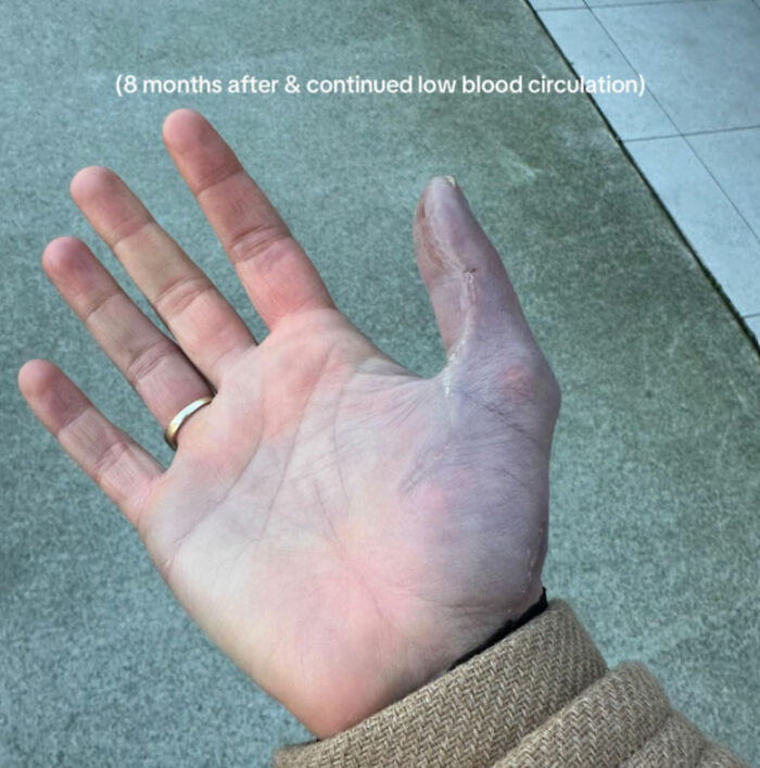 Hand showing signs of low blood circulation eight months after visiting a nail salon, highlighting health risks.
