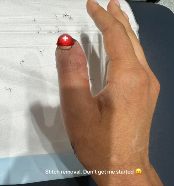 Close-up of a finger with stitches being removed, highlighting nail salon risks and urgent warning about hospital visits.