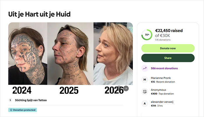 52-year-old woman’s tattoo removal transformation showing fading of 250 name tattoos over three years from 2024 to 2026 52-year-old woman’s tattoo removal transformation showing fading of 250 name tattoos over three years from 2024 to 2026