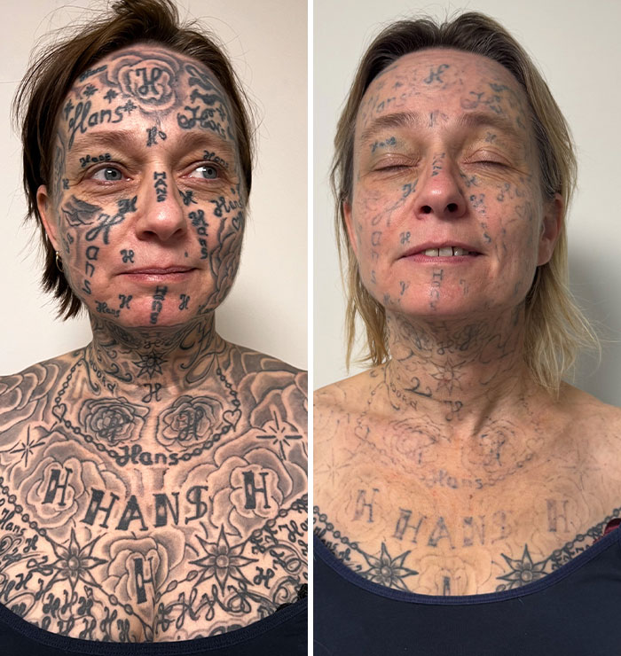 52-year-old woman's tattoo removal transformation after forced 250 tattoos of partner's name on face and chest. 52-year-old woman's tattoo removal transformation after forced 250 tattoos of partner's name on face and chest.