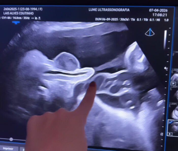 Ultrasound image showing a pregnant doctor pointing at baby peeing inside the womb in a viral video.