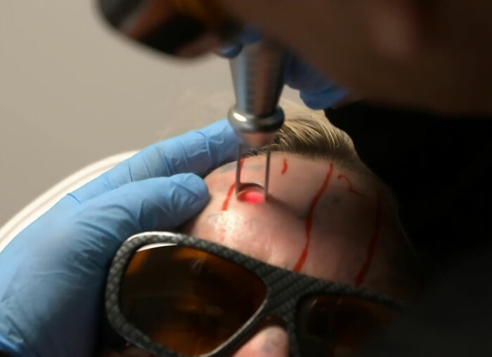 Close-up of a tattoo removal procedure on a woman's forehead using a laser device and protective eyewear. Close-up of a tattoo removal procedure on a woman's forehead using a laser device and protective eyewear.