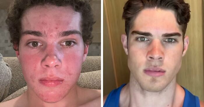 From Bone Smashing To Chin Extensions, Here Are Before-And-After Collages Of “Looksmaxxing” Influencers