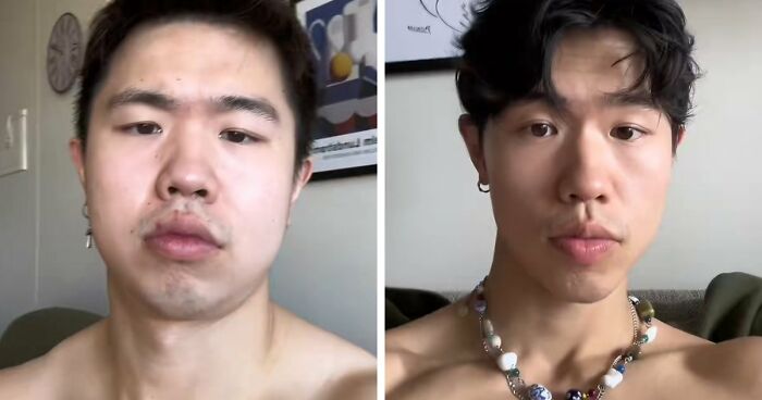 From Bone Smashing To Chin Extensions, Here Are Before-And-After Collages Of “Looksmaxxing” Influencers