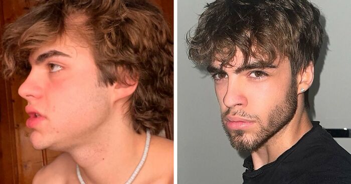 From Bone Smashing To Chin Extensions, Here Are Before-And-After Collages Of “Looksmaxxing” Influencers