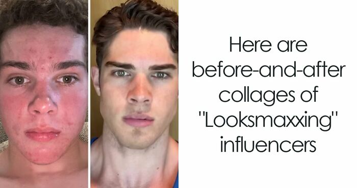 From Bone Smashing To Chin Extensions, Here Are Before-And-After Collages Of “Looksmaxxing” Influencers