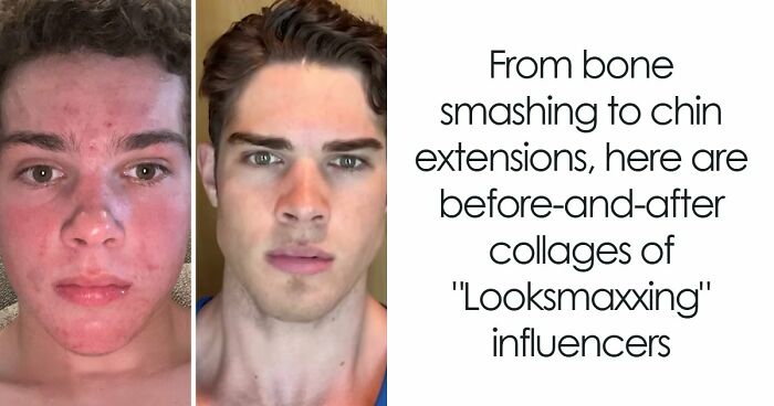 From Bone Smashing To Chin Extensions, Here Are Before-And-After Collages Of “Looksmaxxing” Influencers
