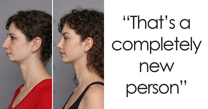 “Best Facial Harmonization I’ve Ever Seen”: 25 Before-And-Afters By A Plastic Surgeon Whose Work Went Viral