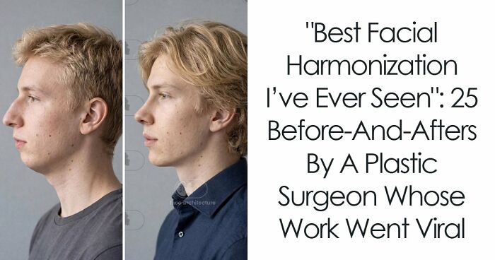 “Best Facial Harmonization I’ve Ever Seen”: 25 Before-And-Afters By A Plastic Surgeon Whose Work Went Viral