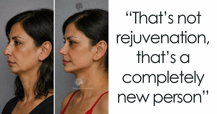“Best Facial Harmonization I’ve Ever Seen”: 25 Before-And-Afters By A Plastic Surgeon Whose Work Went Viral