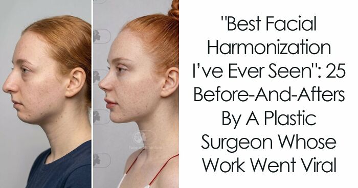 “Best Facial Harmonization I’ve Ever Seen”: 25 Before-And-Afters By A Plastic Surgeon Whose Work Went Viral