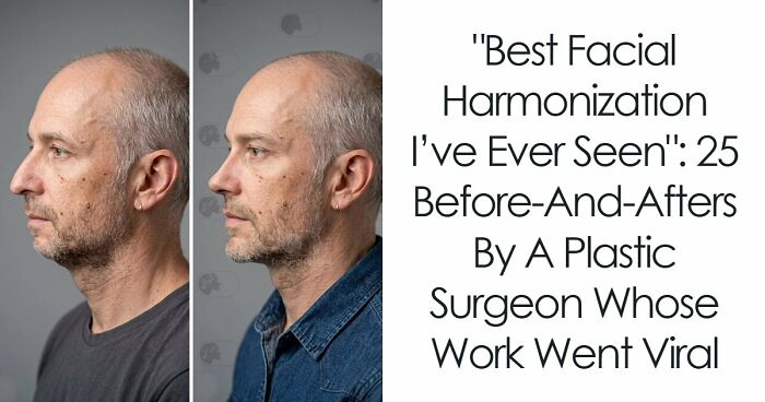 “Best Facial Harmonization I’ve Ever Seen”: 25 Before-And-Afters By A Plastic Surgeon Whose Work Went Viral