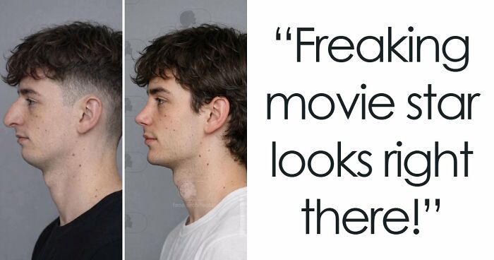 “Best Facial Harmonization I’ve Ever Seen”: 25 Before-And-Afters By A Plastic Surgeon Whose Work Went Viral