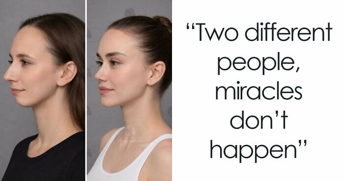 “Best Facial Harmonization I’ve Ever Seen”: 25 Before-And-Afters By A Plastic Surgeon Whose Work Went Viral