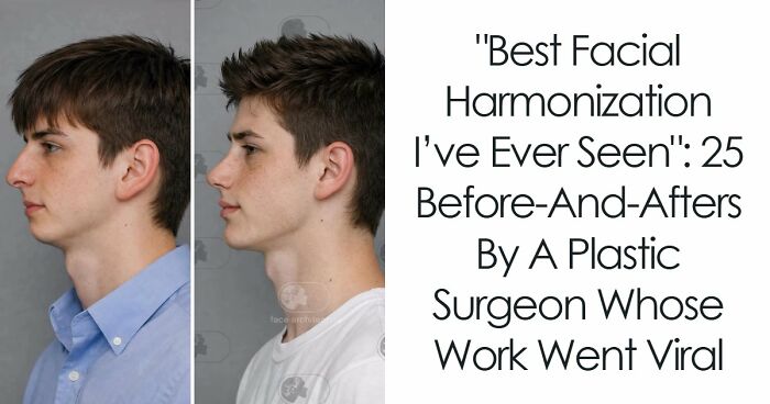 “Best Facial Harmonization I’ve Ever Seen”: 25 Before-And-Afters By A Plastic Surgeon Whose Work Went Viral