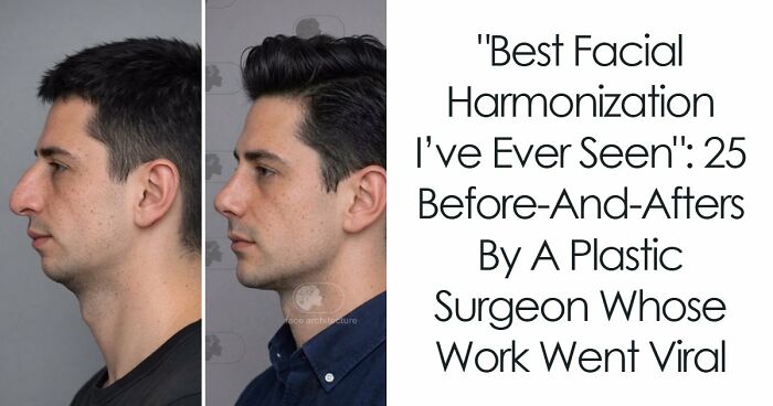 “Best Facial Harmonization I’ve Ever Seen”: 25 Before-And-Afters By A Plastic Surgeon Whose Work Went Viral