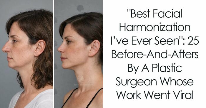 “Best Facial Harmonization I’ve Ever Seen”: 25 Before-And-Afters By A Plastic Surgeon Whose Work Went Viral
