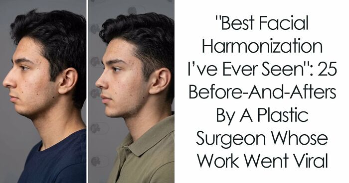 “Best Facial Harmonization I’ve Ever Seen”: 25 Before-And-Afters By A Plastic Surgeon Whose Work Went Viral