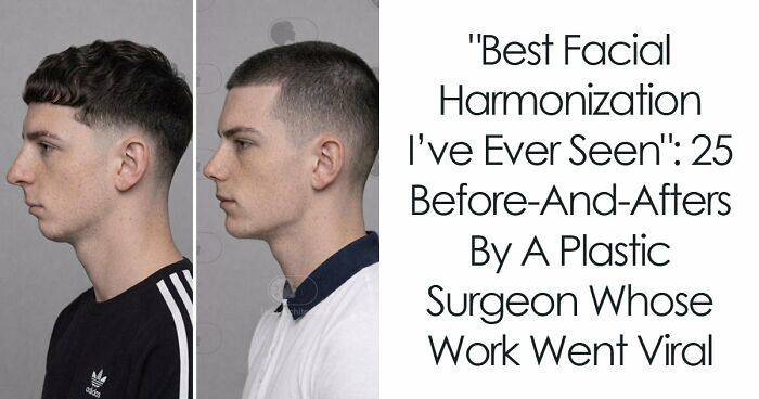 “Best Facial Harmonization I’ve Ever Seen”: 25 Before-And-Afters By A Plastic Surgeon Whose Work Went Viral
