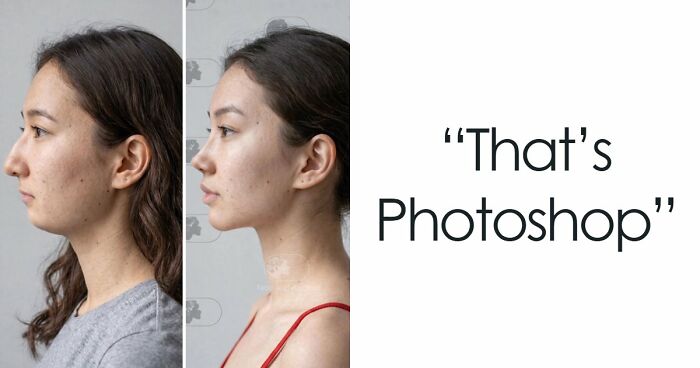 “Best Facial Harmonization I’ve Ever Seen”: 25 Before-And-Afters By A Plastic Surgeon Whose Work Went Viral