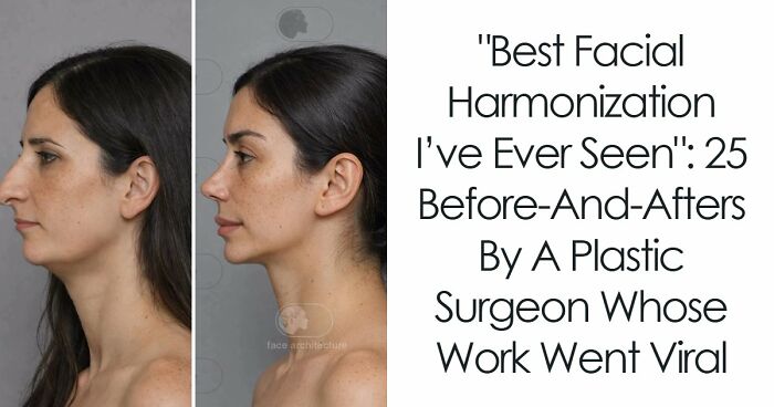 “Best Facial Harmonization I’ve Ever Seen”: 25 Before-And-Afters By A Plastic Surgeon Whose Work Went Viral