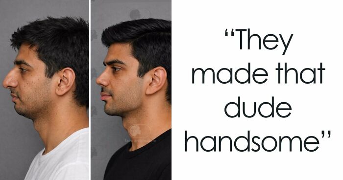 “Best Facial Harmonization I’ve Ever Seen”: 25 Before-And-Afters By A Plastic Surgeon Whose Work Went Viral