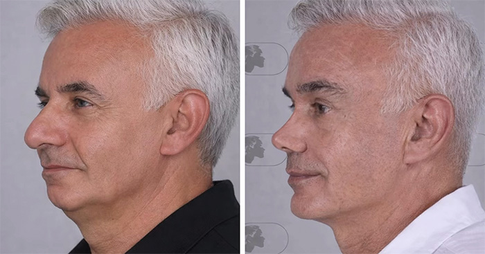 “Best Facial Harmonization I’ve Ever Seen”: 25 Before-And-Afters By A Plastic Surgeon Whose Work Went Viral