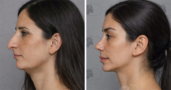 “Best Facial Harmonization I’ve Ever Seen”: 25 Before-And-Afters By A Plastic Surgeon Whose Work Went Viral