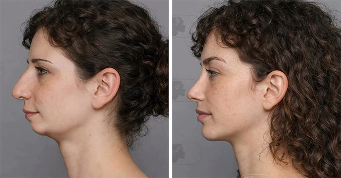 “Best Facial Harmonization I’ve Ever Seen”: 25 Before-And-Afters By A Plastic Surgeon Whose Work Went Viral