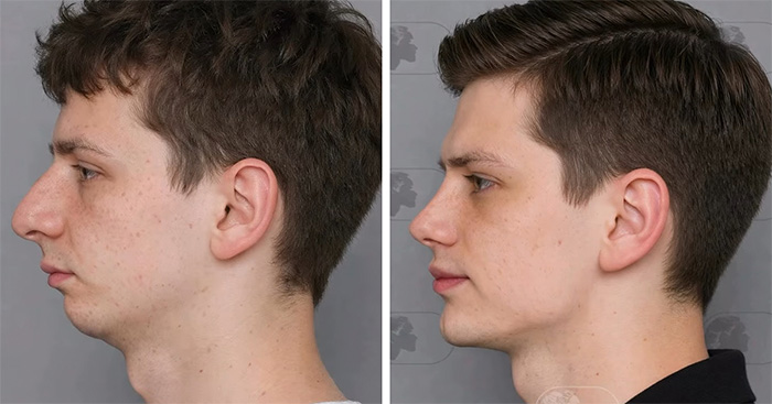 “Best Facial Harmonization I’ve Ever Seen”: 25 Before-And-Afters By A Plastic Surgeon Whose Work Went Viral