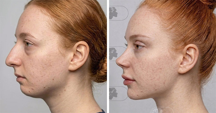 “Best Facial Harmonization I’ve Ever Seen”: 25 Before-And-Afters By A Plastic Surgeon Whose Work Went Viral