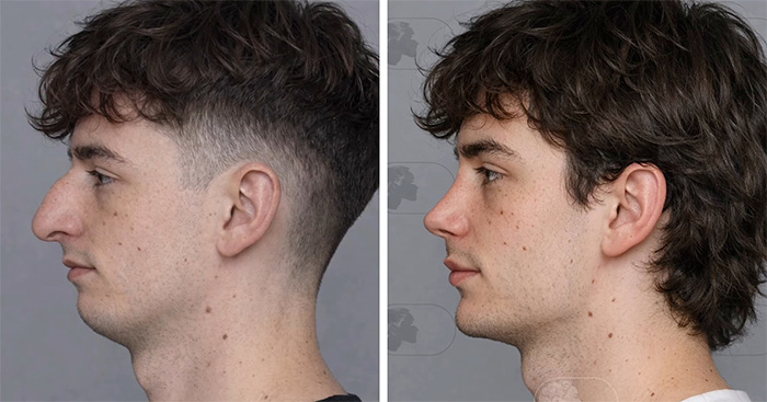 “Best Facial Harmonization I’ve Ever Seen”: 25 Before-And-Afters By A Plastic Surgeon Whose Work Went Viral