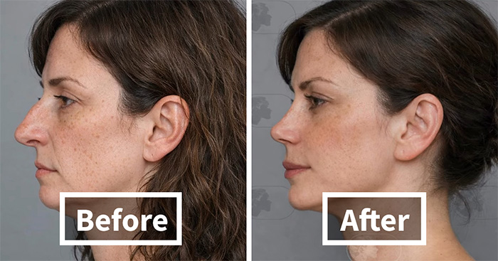 “Best Facial Harmonization I’ve Ever Seen”: 25 Before-And-Afters By A Plastic Surgeon Whose Work Went Viral