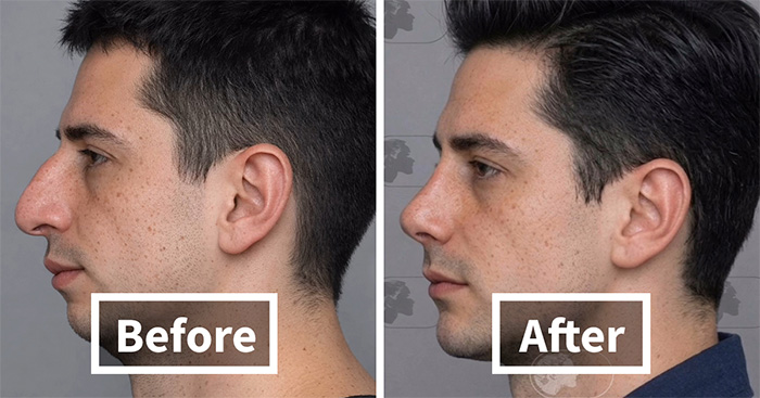 “Best Facial Harmonization I’ve Ever Seen”: 25 Before-And-Afters By A Plastic Surgeon Whose Work Went Viral