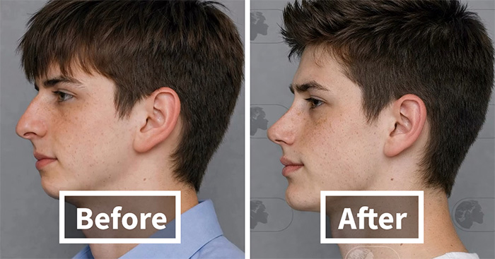 “Best Facial Harmonization I’ve Ever Seen”: 25 Before-And-Afters By A Plastic Surgeon Whose Work Went Viral