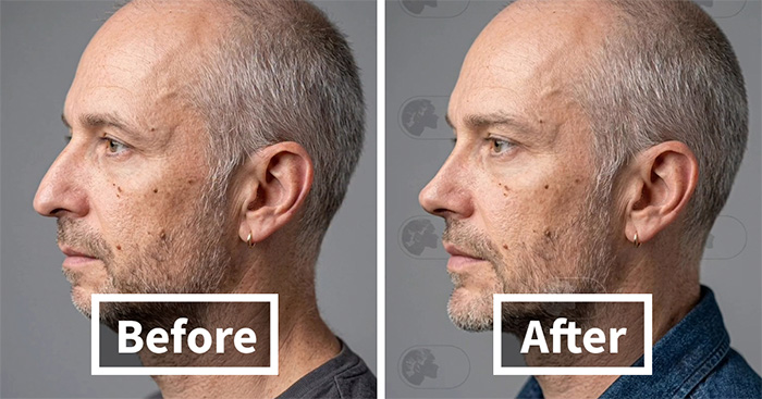 “Best Facial Harmonization I’ve Ever Seen”: 25 Before-And-Afters By A Plastic Surgeon Whose Work Went Viral