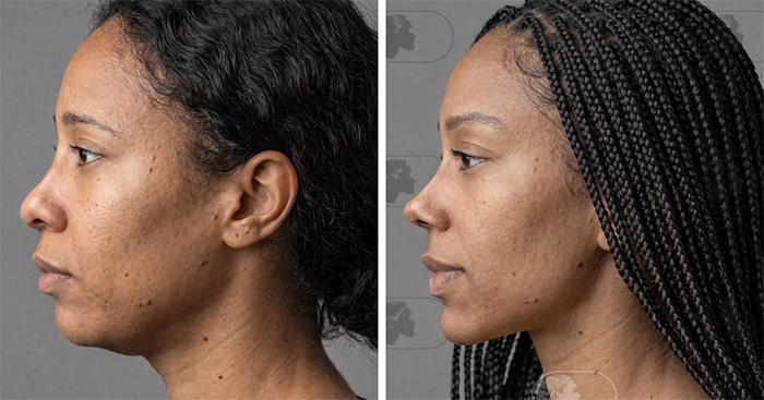 “Best Facial Harmonization I’ve Ever Seen”: 25 Before-And-Afters By A Plastic Surgeon Whose Work Went Viral