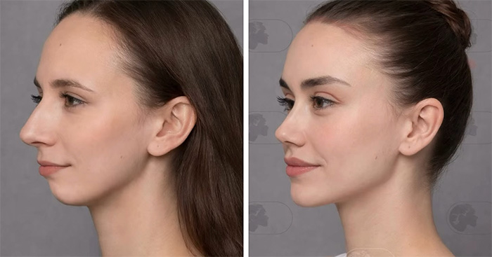 “Best Facial Harmonization I’ve Ever Seen”: 25 Before-And-Afters By A Plastic Surgeon Whose Work Went Viral