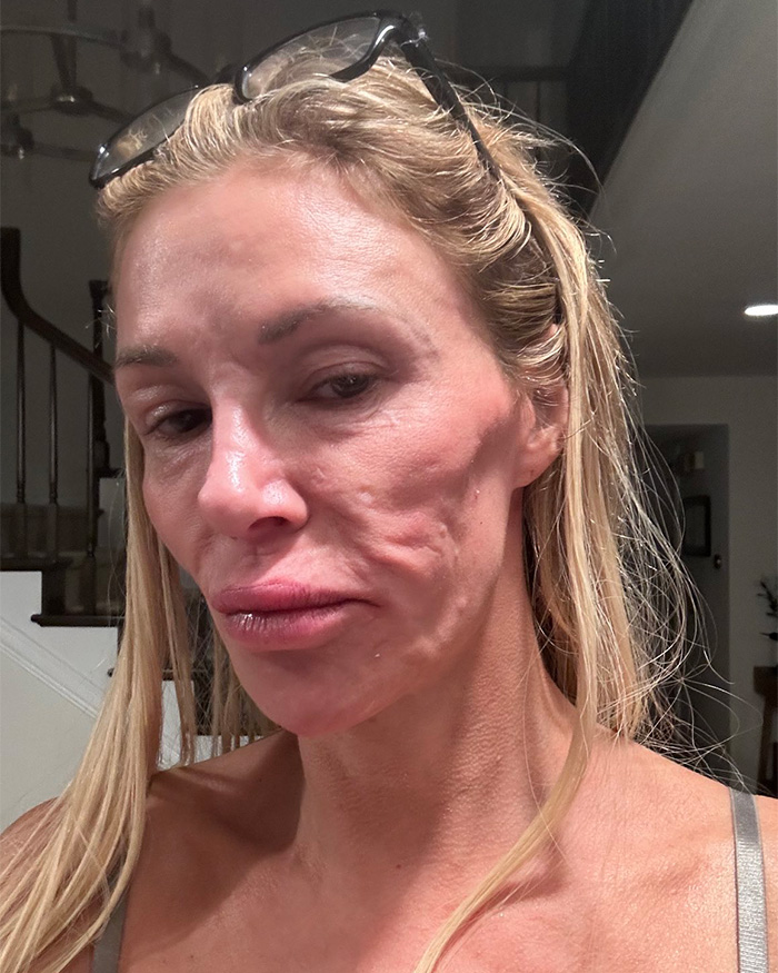 Brandi Glanville correu para atendimento de urgência depois de tentar a perigosa tendência médica do TikTok Brandi Glanville correu para atendimento de urgência depois de tentar a perigosa tendência médica do TikTok