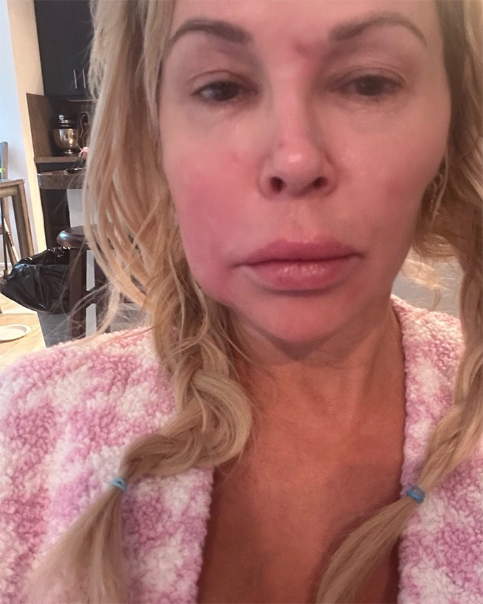 Brandi Glanville correu para atendimento de urgência depois de tentar a perigosa tendência médica do TikTok Brandi Glanville correu para atendimento de urgência depois de tentar a perigosa tendência médica do TikTok