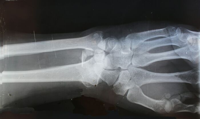 X-ray of a wrist and hand bones highlighting strength and resilience, relating to life dealing with horrible bullies.