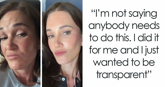 15 Times Celebrities And Influencers Shared Their Plastic Surgery Results Openly