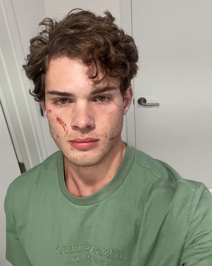 ‘Looksmaxxing’ Influencer Clavicular Breaks Silence After ‘Brutal’ Hospitalization Following Live Incident