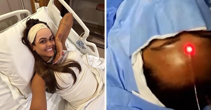 This Influencer Removed A Vein From Her Forehead Because It Bothered Her Aesthetically And Shared The Results