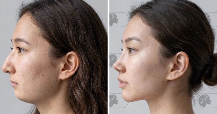 “Best Facial Harmonization I’ve Ever Seen”: 25 Before-And-Afters By A Plastic Surgeon Whose Work Went Viral
