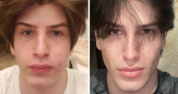 From Bone Smashing To Chin Extensions, Here Are Before-And-After Collages Of “Looksmaxxing” Influencers