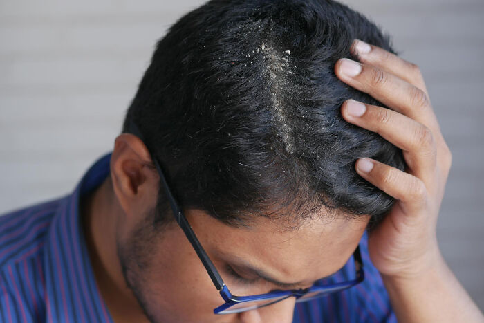 Man with dandruff on his scalp and glasses looking down, illustrating unhinged reasons people left mid-date.