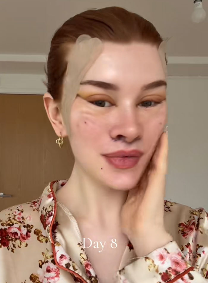 A young woman, Day 8 post-facelift, with bandages near her temples and bruising under her eyes, sparking debate on society's new normal.